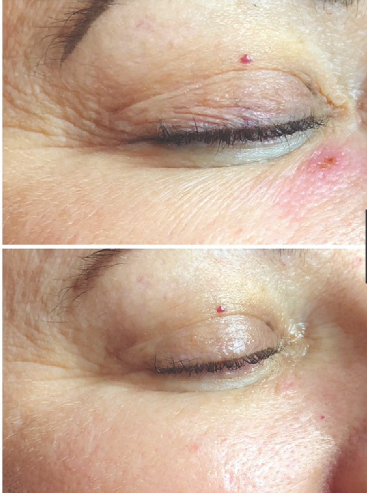 Resultaat microneedling