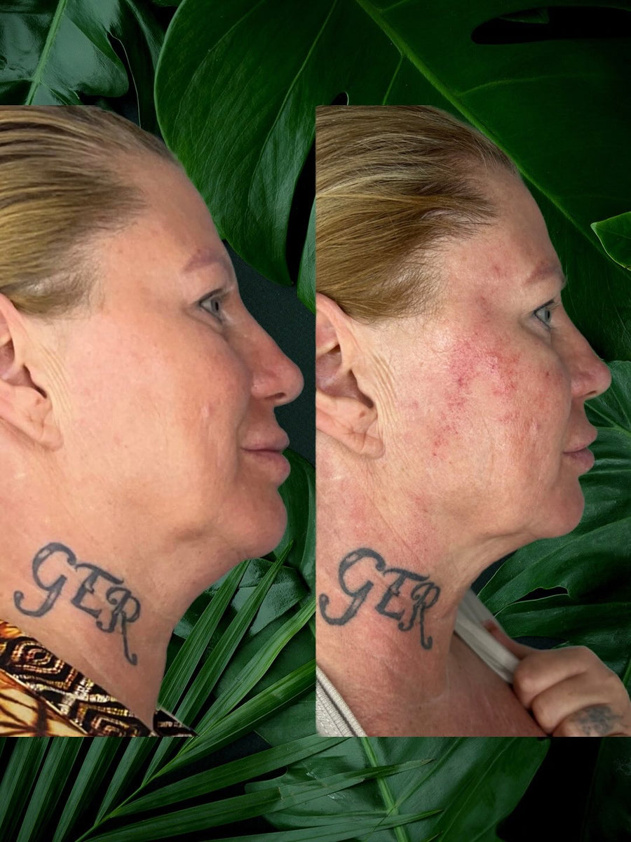Huid na dermaplaning