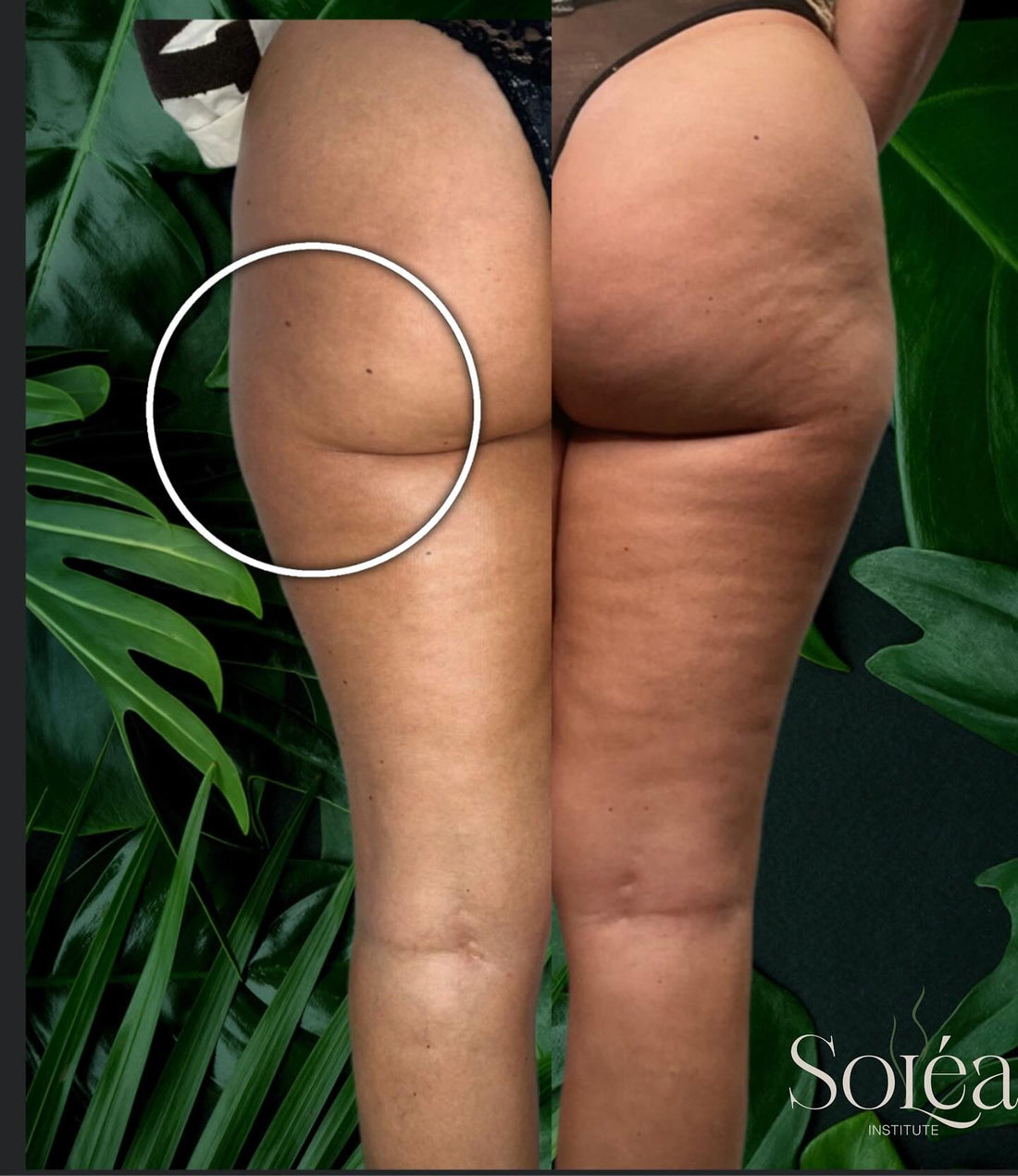 Resultaat dermaplaning