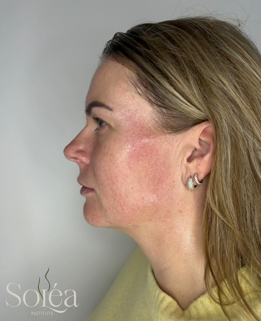 Resultaat dermaplaning
