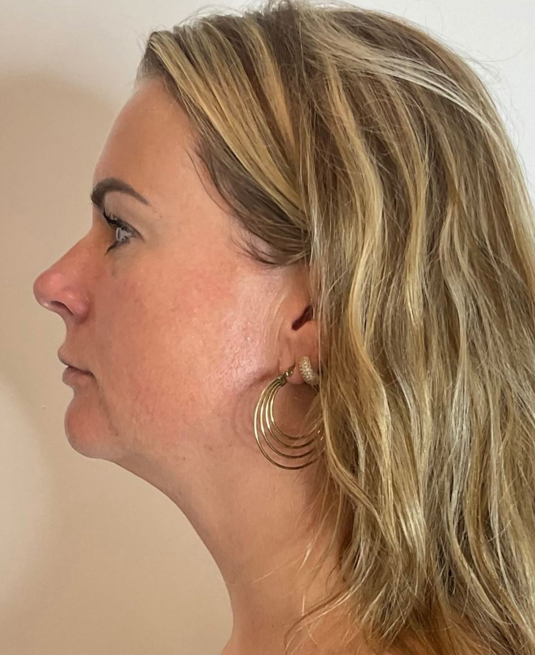Stralende huid na dermaplaning