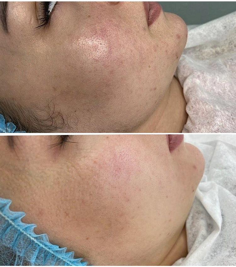 Resultaat microneedling