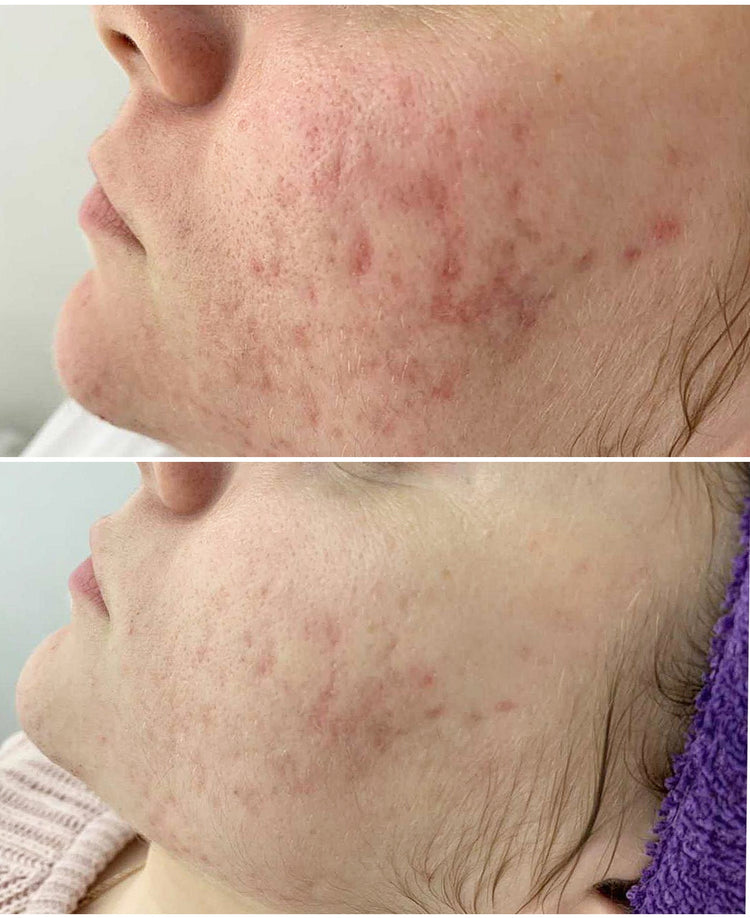 Resultaat microneedling