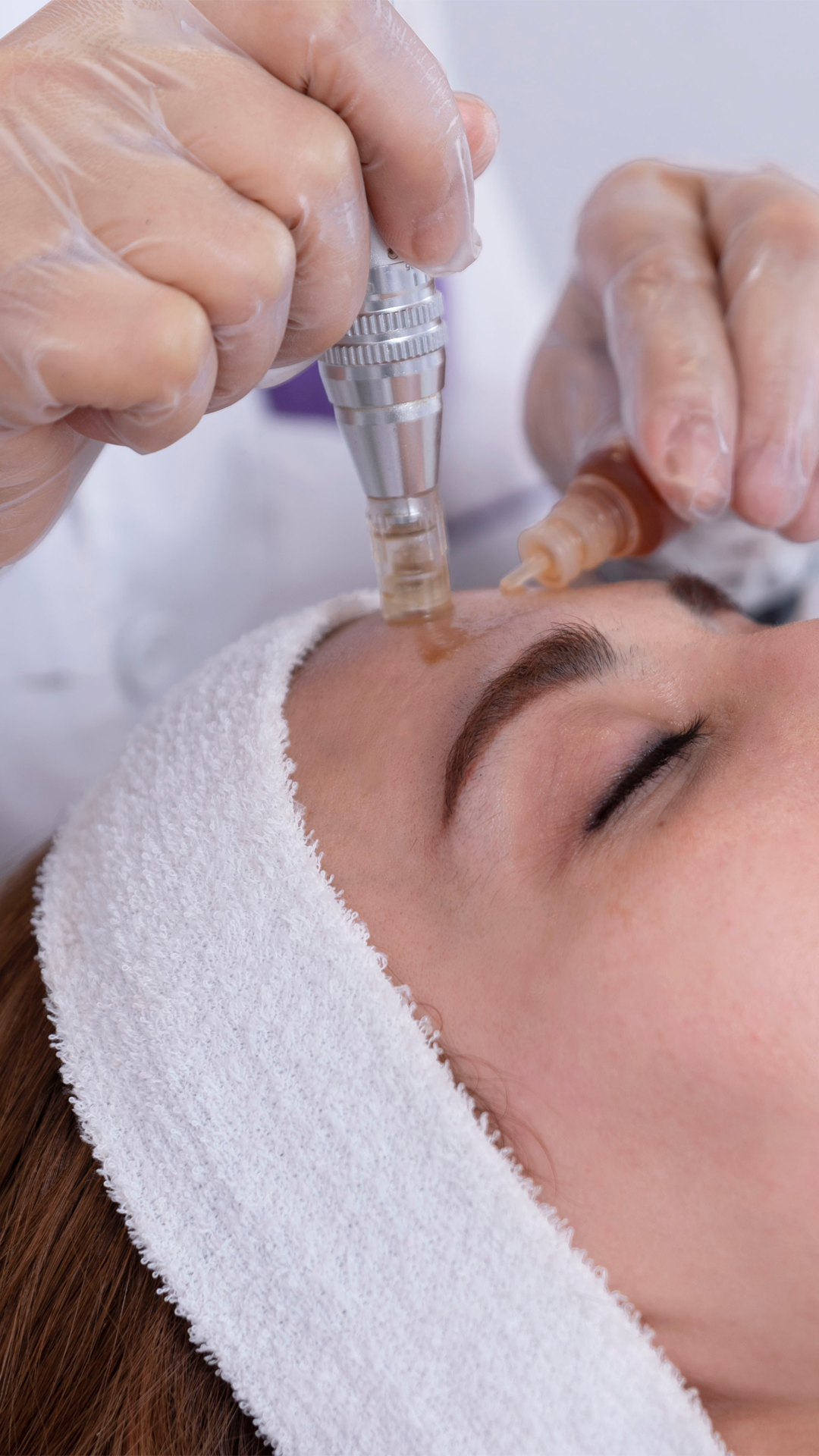 Microneedling bij Soléa Institute
