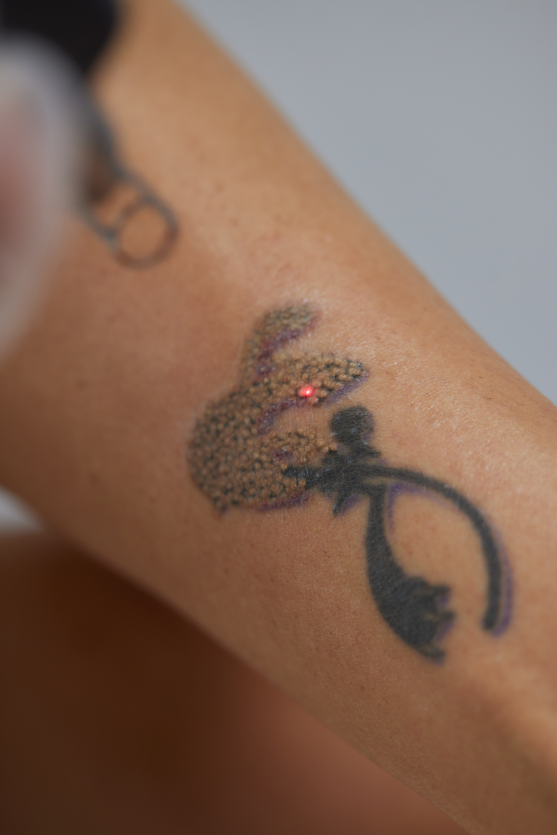 Laser tattooverwijdering bij Soléa Institute