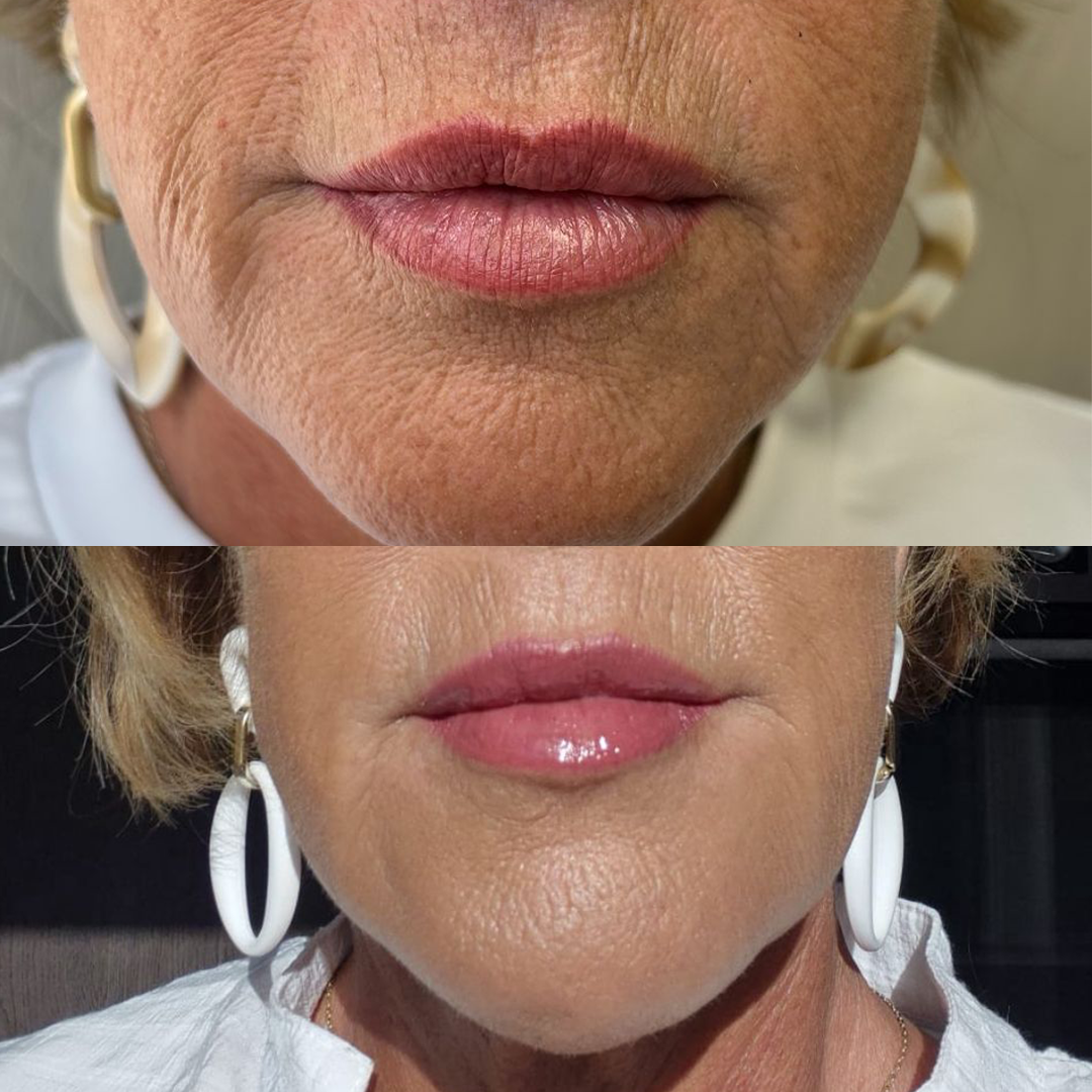 Voor en na dermaplaning bij Soléa Institute